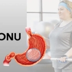 Allurion Mide Balonu