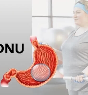 Allurion Mide Balonu