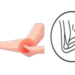 Kubital Tünel Ameliyatı: Dirsekte Sinir Sıkışma