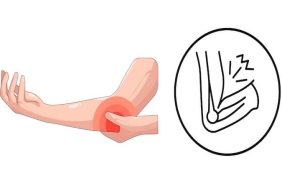 Kubital Tünel Ameliyatı: Dirsekte Sinir Sıkışma