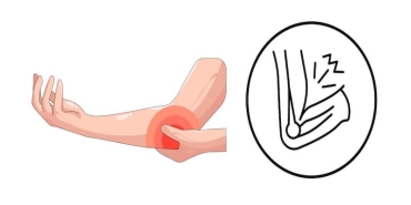 Kubital Tünel Ameliyatı: Dirsekte Sinir Sıkışma