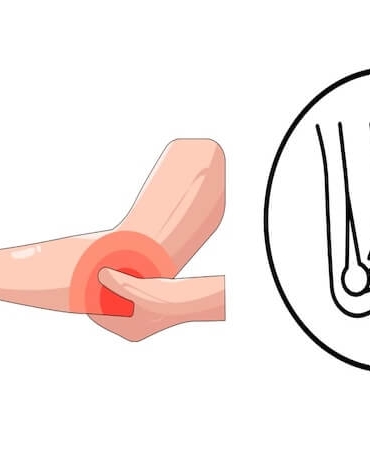 Kubital Tünel Ameliyatı: Dirsekte Sinir Sıkışma