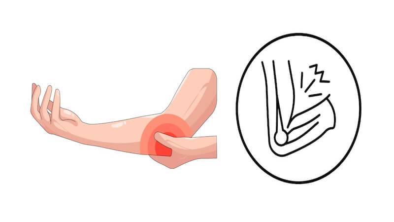 Kubital Tünel Ameliyatı: Dirsekte Sinir Sıkışma